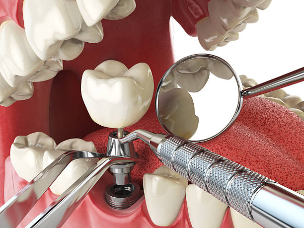 Best Knocked-Out Tooth (Avulsed Tooth) Treatment in Plum, PA